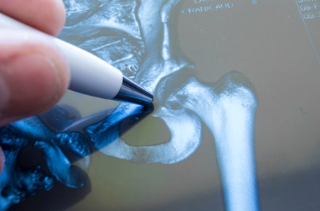3D Scan of hip fracture